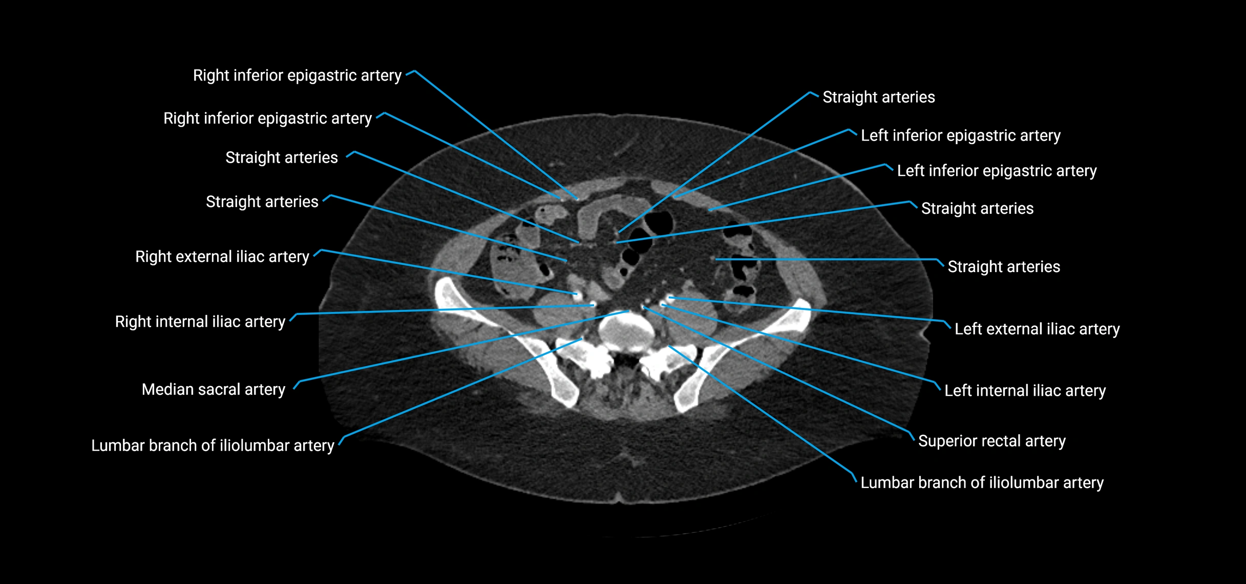 CTA abdomen axial cross sectional anatomy labelled image_176 (2).webp